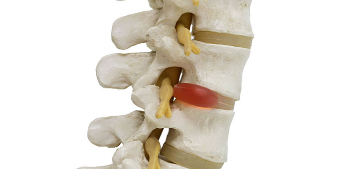 Herniated disc in spine before visiting Boise chiropractor