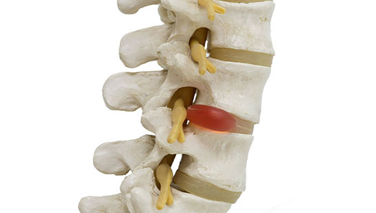 Herniated disc in spine before visiting Boise chiropractor