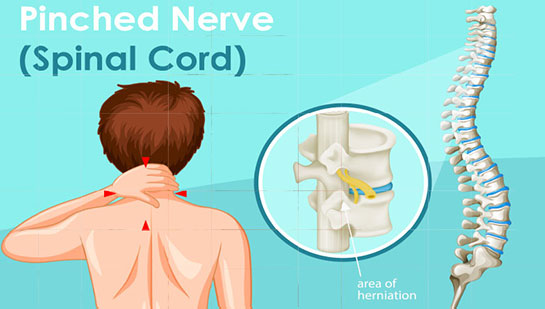 Pinched nerve in spine before chiropractic treatment from Boise chiropractor