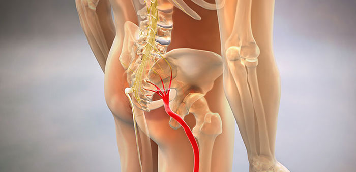 Sciatic nerve pain before chiropractic treatment from Boise chiropractor