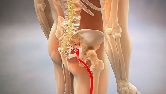 Sciatic nerve pain before chiropractic treatment from Boise chiropractor