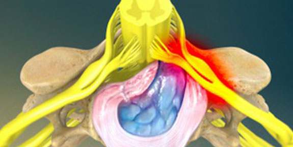 Herniated Disc Boise